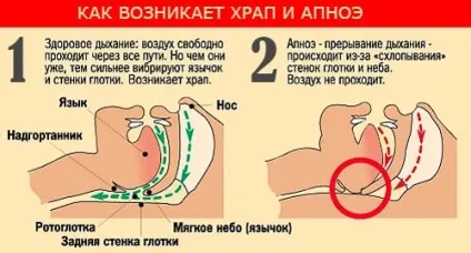Народні засоби від хропіння у жінок (хропіння) Народні засоби від хропіння у жінок