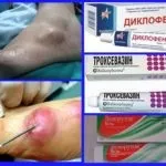 На стопі з'явилося ущільнення і болить причини ущільнення стоп (Лікування ущільнень стопі) На стопі з'явилося ущільнення і болить причини ущільнення стоп