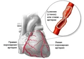 Наскільки серйозний синдром (хвороба) Такаясу і як його лікувати (хвороба Такаясу) Наскільки серйозний синдром (хвороба) Такаясу і як його лікувати