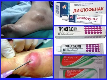 На стопі з'явилося ущільнення і болить причини ущільнення стоп (стопі) На стопі з'явилося ущільнення і болить причини ущільнення стоп