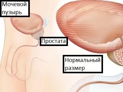 Норма розмірів простати у чоловіків по віковим групам - норма об'єму простати (чоловіків) Норма розмірів простати у чоловіків по віковим групам - норма об'єму простати