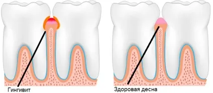Ниючий біль в яснах - основні причини, лікування (яснах) Ниючий біль в яснах - основні причини, лікування