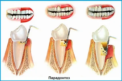 Ниючий біль в яснах - основні причини, лікування (причини) Ниючий біль в яснах - основні причини, лікування