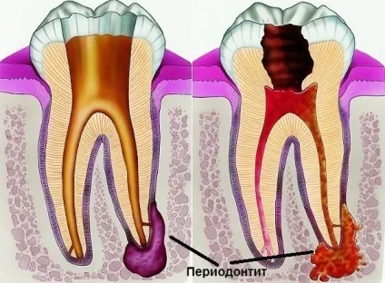 Ниючий біль в яснах - основні причини, лікування (ниючий) Ниючий біль в яснах - основні причини, лікування