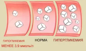 Некомпенсований цукровий діабет що це таке (хотілося звернути увагу) Некомпенсований цукровий діабет що це таке