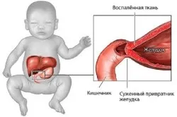 Непрохідність кишечника у новонароджених причини і симптоми (кишечника) Непрохідність кишечника у новонароджених причини і симптоми