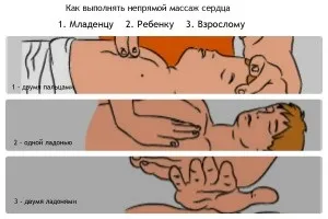 Непрямий масаж серця техніка виконання 1