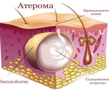 Неприємний запах за вухами у дорослих причини і чим лікувати