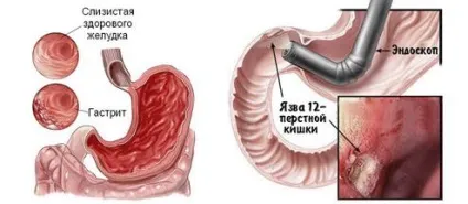 Нетравлення шлунка симптоми у дитини, лікування ліками і народними засобами, дієта для дітей (лікування) Нетравлення шлунка симптоми у дитини, лікування ліками і народними засобами, дієта для дітей