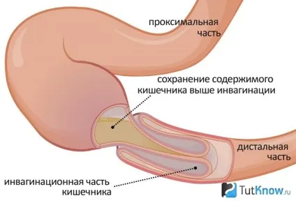 Непрохідність кишечника у новонароджених симптоми, причини (новонароджених) Непрохідність кишечника у новонароджених симптоми, причини