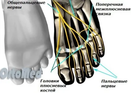 Неврома Мортона лікування, діагностика, операція, симптоми, фото (лікування операція діагностика фото симптоми неврома Мортона) Неврома Мортона лікування, діагностика, операція, симптоми, фото