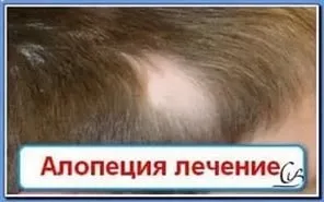 Облисіння у жінок картинки - новини - жіноче облисіння 8 букв (облисіння жінок картинки) Облисіння у жінок картинки - новини - жіноче облисіння 8 букв