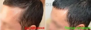 Облисіння у жінок картинки - новини - жіноче облисіння 8 букв (жінок) Облисіння у жінок картинки - новини - жіноче облисіння 8 букв