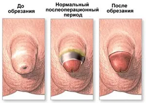Обрізання, мій уролог