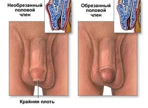 Обрізання, мій уролог