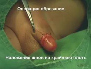Обрізання, мій уролог