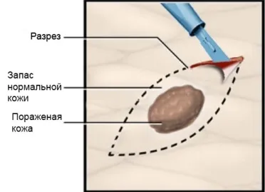Загальна Ексцизійна біопсія