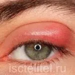 Дуже сильно сльозяться очі (сильно) Дуже сильно сльозяться очі