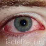 Дуже сильно сльозяться очі (сльозяться) Дуже сильно сльозяться очі