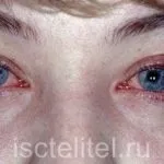 Дуже сильно сльозяться очі (сльозяться) Дуже сильно сльозяться очі