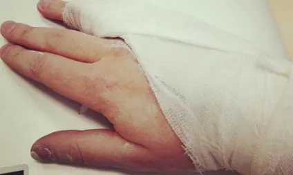 Про що потрібно пам'ятати, накладаючи гіпсову пов'язку на руку (гіпсову) Про що потрібно пам'ятати, накладаючи гіпсову пов'язку на руку