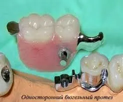 Односторонній бюгельний протез