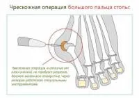 Операція халюс вальгус - особливості, реабілітація (халюс) Операція халюс вальгус - особливості, реабілітація