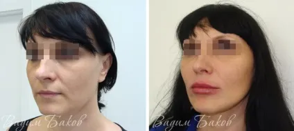 Омолодження особи без операції чи можливо таке 300 (особи) Омолодження особи без операції чи можливо таке 300