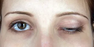 Опущення верхньої повіки (птоз) (опущення верхньої повіки птоз) Опущення верхньої повіки (птоз)