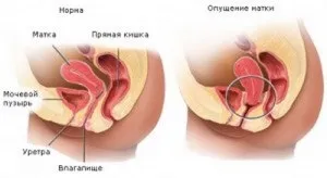 Опущення матки - сучасні методи лікування (лікування) Опущення матки - сучасні методи лікування