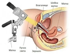Опущення матки - сучасні методи лікування (методи) Опущення матки - сучасні методи лікування
