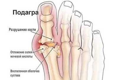 Опух палець на нозі в чому причина і що потрібно робити