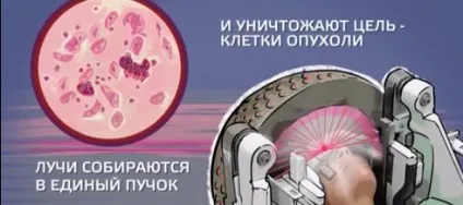 Пухлина головного мозку симптоми і види лікування (мозку) Пухлина головного мозку симптоми і види лікування
