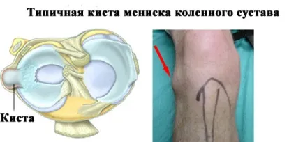 Пухлина під коліном види, симптоми і лікування (коліном) Пухлина під коліном види, симптоми і лікування