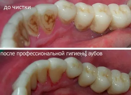 Опущення ясен лікування, що робити і як підняти (опущення) Опущення ясен лікування, що робити і як підняти