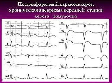 Ускладнення після інфаркту міокарда (інфаркту) Ускладнення після інфаркту міокарда