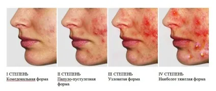 Від чого з'являються вугри (акне) на обличчі (чого) Від чого з'являються вугри (акне) на обличчі
