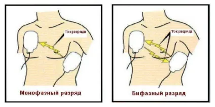 Особливості вибору дефібрилятора
