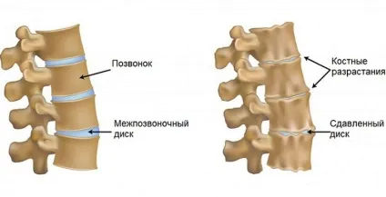 Остеохондроз поперекового відділу хребта симптоми і лікування, причини, діагностика (симптоми) Остеохондроз поперекового відділу хребта симптоми і лікування, причини, діагностика