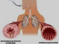 Набряк бронхів симптоми і методи лікування - бронхіальна астма - бронхіт - пульмонологія і фтизіатрія (симптоми) Набряк бронхів симптоми і методи лікування - бронхіальна астма - бронхіт - пульмонологія і фтизіатрія