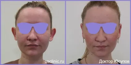 Отопластика (пластика вух, корекція капловухості) - ціни і вартість (пластика) Отопластика (пластика вух, корекція капловухості) - ціни і вартість