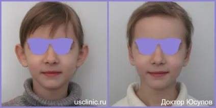Отопластика (пластика вух, корекція капловухості) - ціни і вартість (отопластика) Отопластика (пластика вух, корекція капловухості) - ціни і вартість