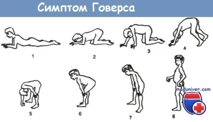 Оцінка м'язової сили у дітей (дітей) Оцінка м'язової сили у дітей