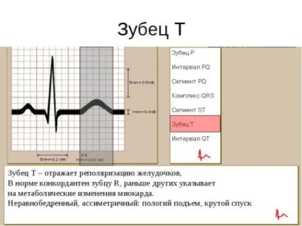 Негативний зубець т на ЕКГ 1 (зубець) Негативний зубець т на ЕКГ 1