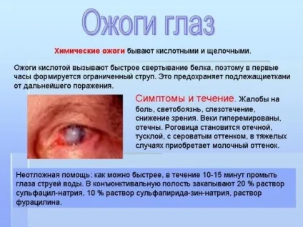 Опіки очей - види, перша допомога та лікування опіків (опіки) Опіки очей - види, перша допомога та лікування опіків