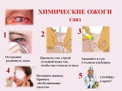 Опіки очей - види, перша допомога та лікування опіків (опіки) Опіки очей - види, перша допомога та лікування опіків