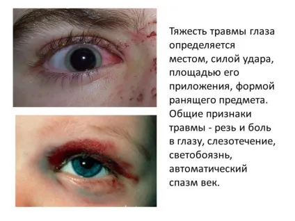 Опіки очей - види, перша допомога та лікування опіків (перша) Опіки очей - види, перша допомога та лікування опіків