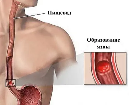 Опік стравоходу симптоми, лікування (симптоми) Опік стравоходу симптоми, лікування