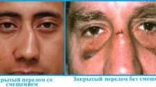 Перелом кісток носа ознаки, фото, симптоми, лікування (кісток) Перелом кісток носа ознаки, фото, симптоми, лікування