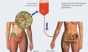 Пересадка кісткового мозку - як відбувається і наслідки, вартість (наслідки) Пересадка кісткового мозку - як відбувається і наслідки, вартість